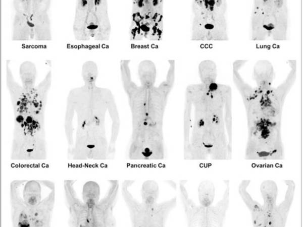 核醫診療賽道上的FAP分子們